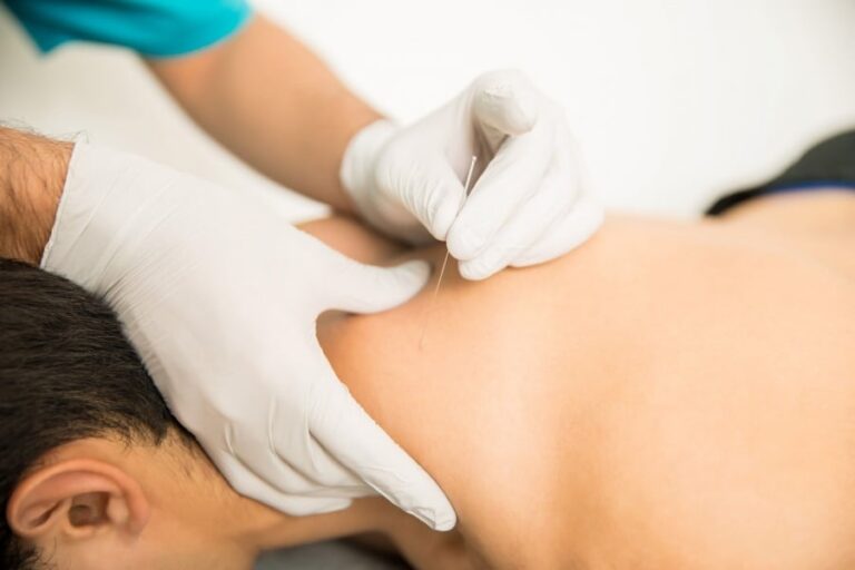 dry needling therapy