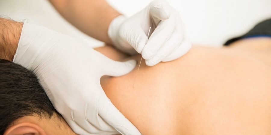 dry needling therapy