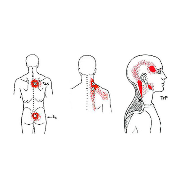 trigger point therapy