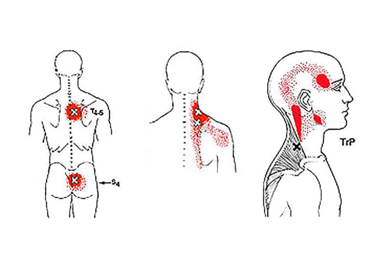 trigger point therapy