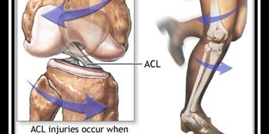 μετεγχειριτικη αποκατασταση προσθιου χιαστου συνδεσμου